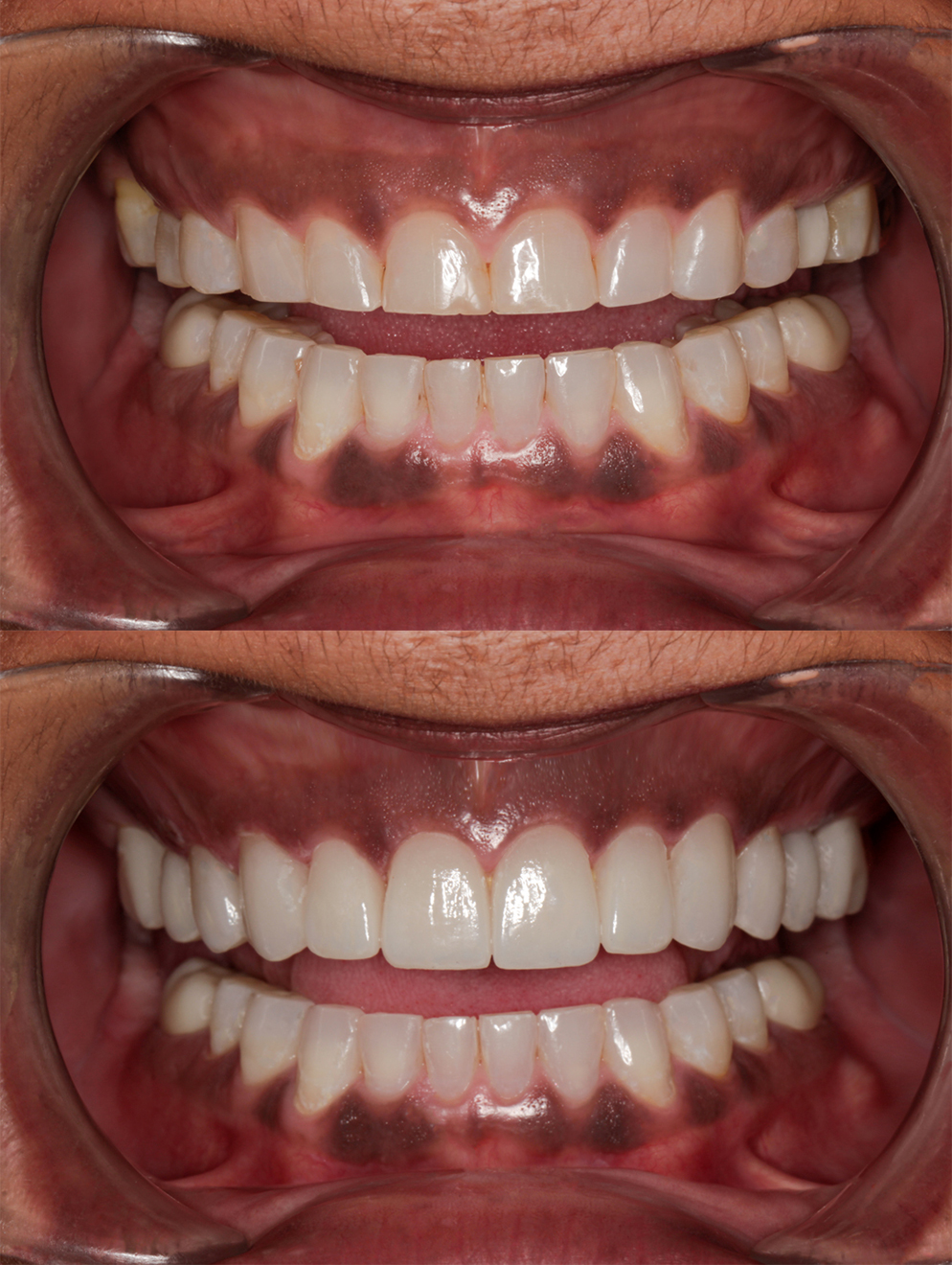 smile-design-before-and-after-44