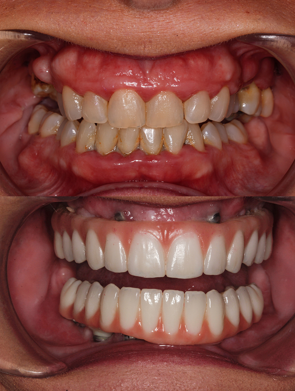 full-mouth-restoration-before-and-after-57
