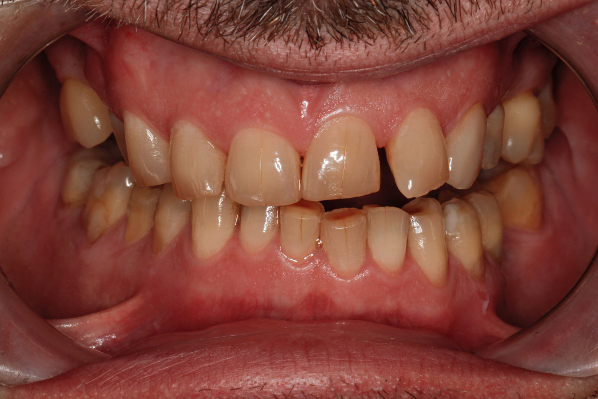 dental-implant-before-case-92