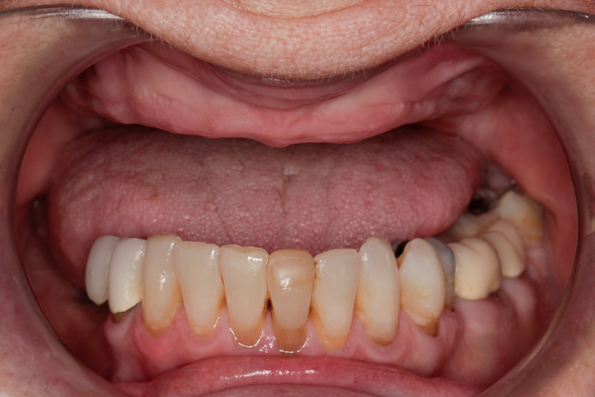 full-mouth-restoration-before-case-88