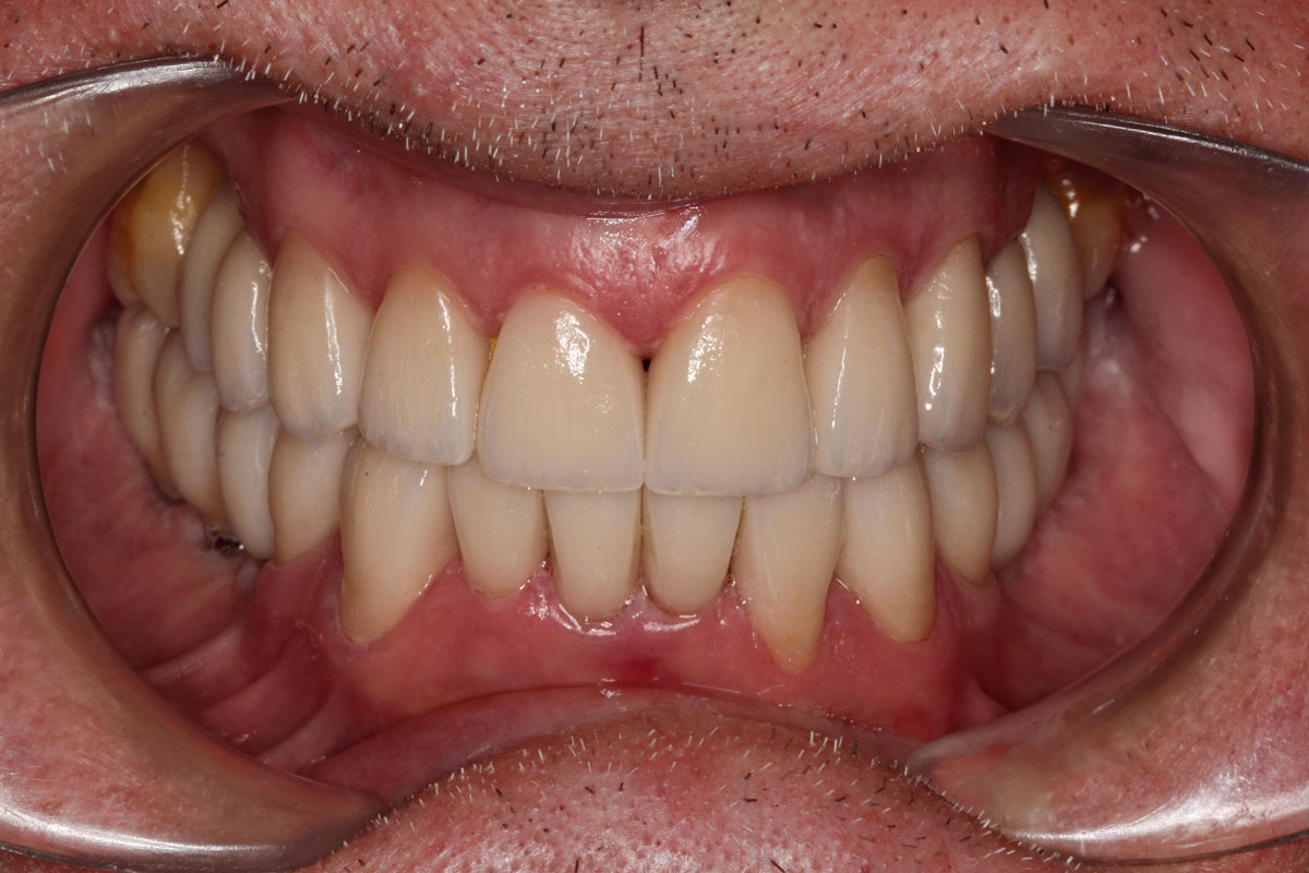implant-dentistry-after-76