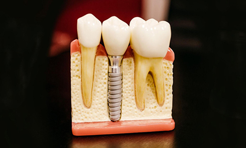 dental implants explained